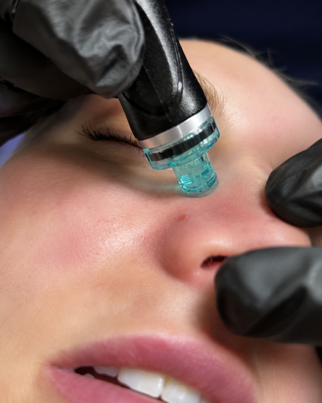 HydraFacial treatment at The One Clinic Leicester