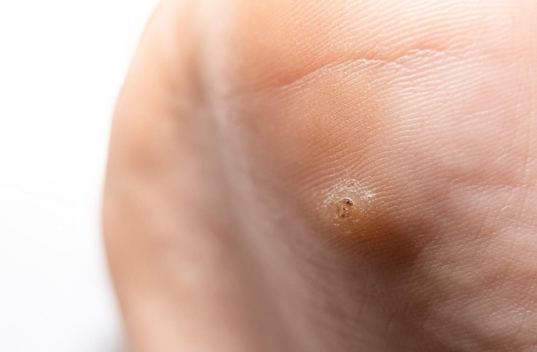 Are Warts Contagious? Understanding Their Spread & Treatments