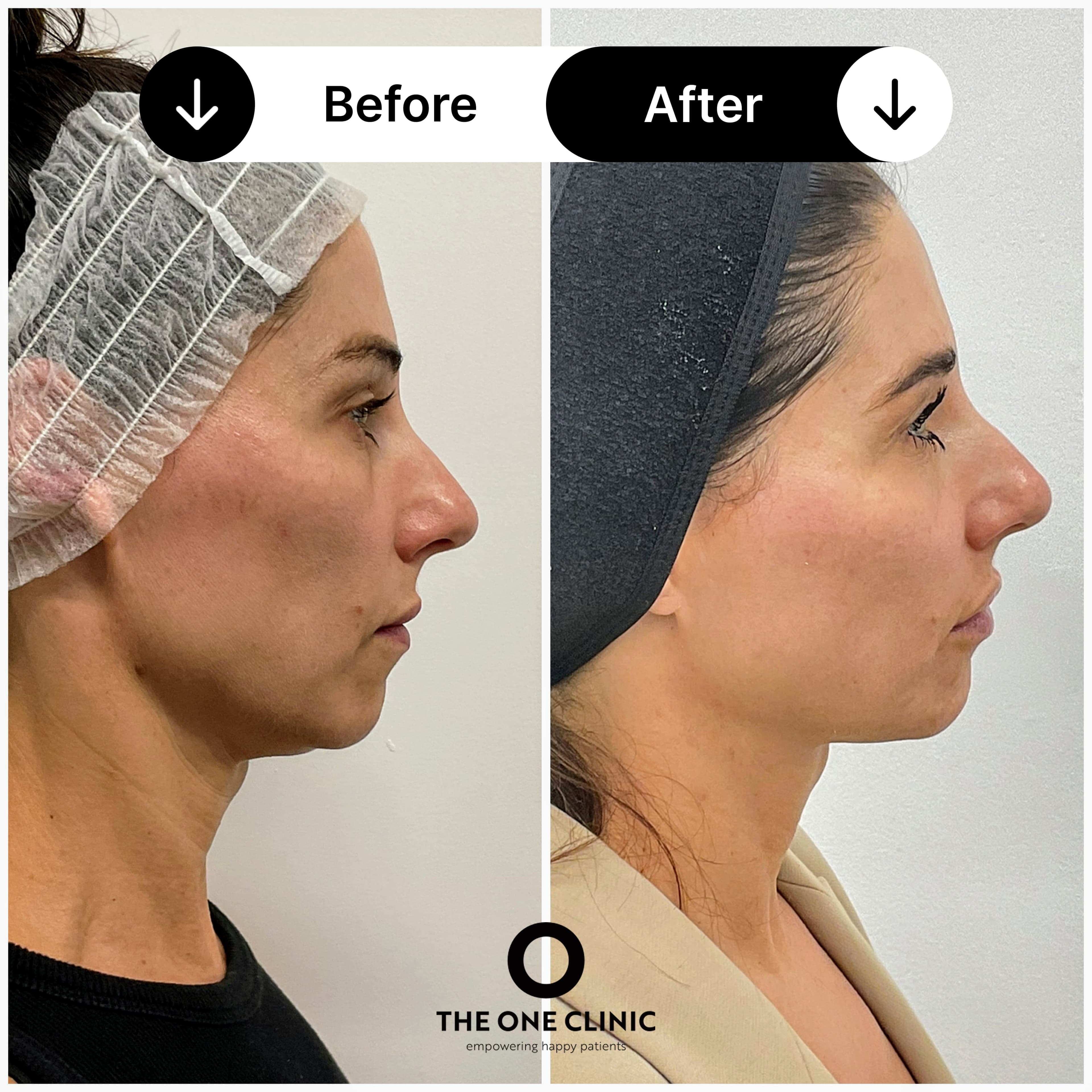 Endolift before and after results