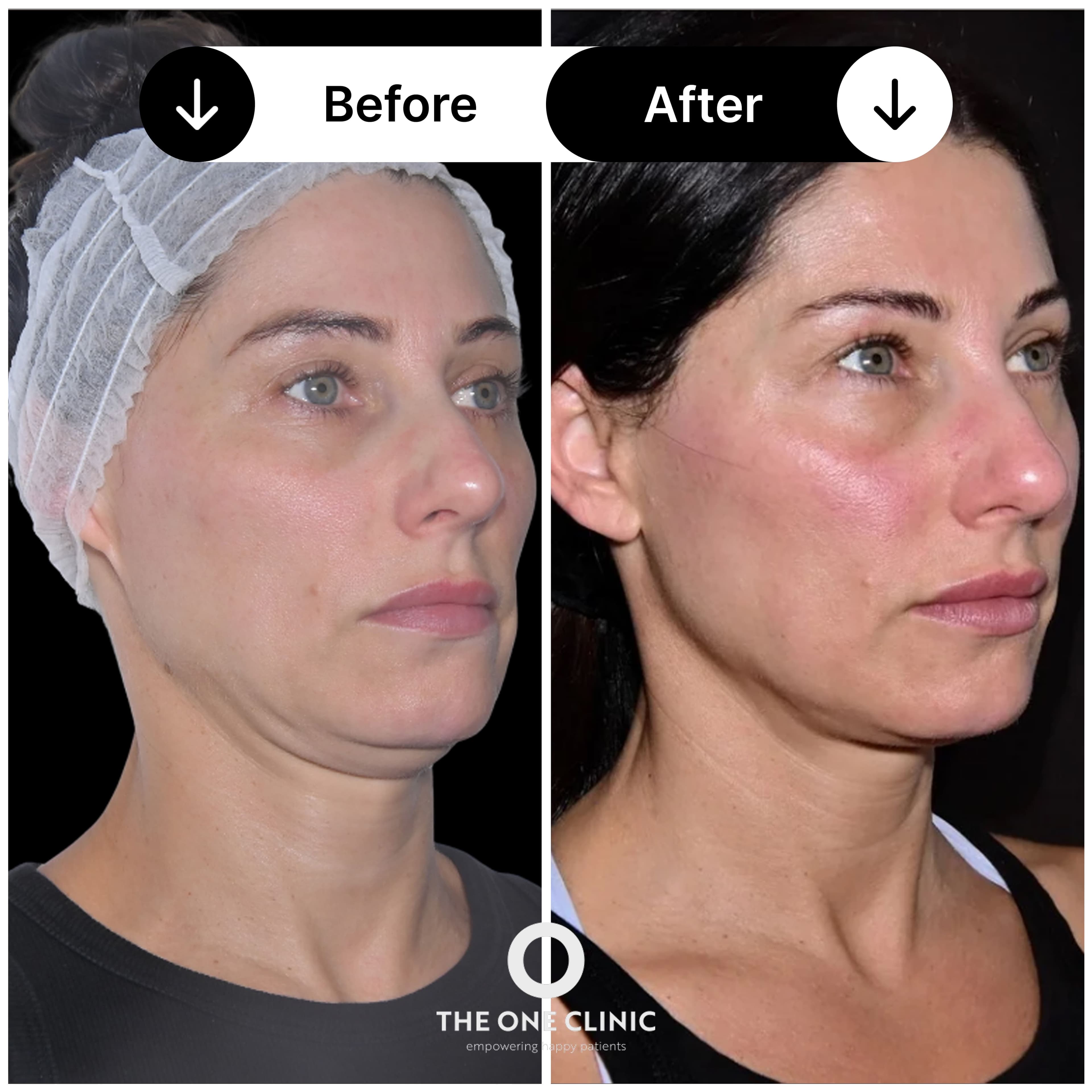 Endolift treatment before and after