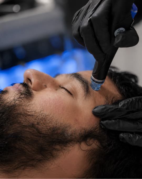 HydraFacial Keravive scalp treatment at The One Clinic Leicester