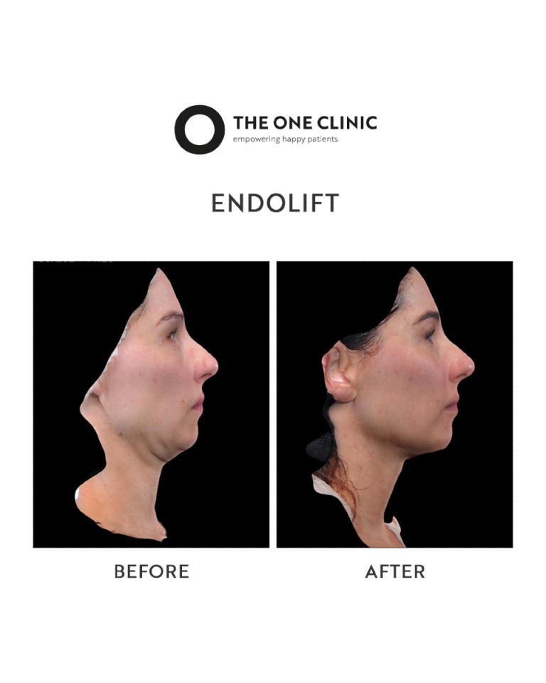 Endolift before & after real result