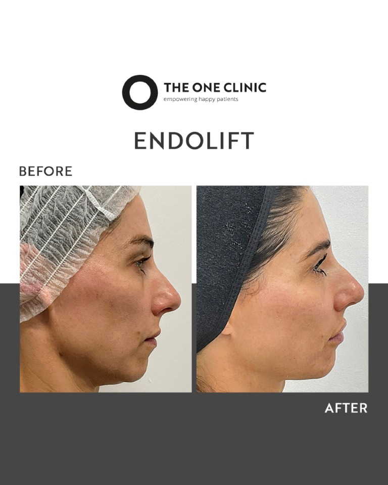 Endolift before & after