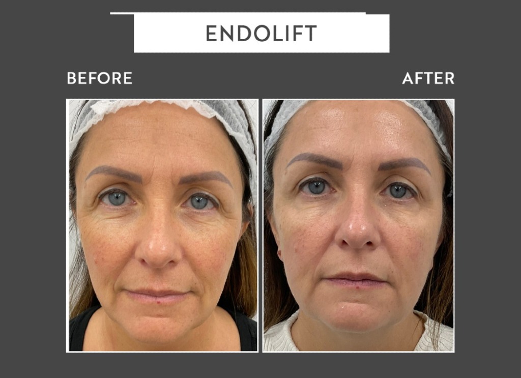 Endolift laser before & after